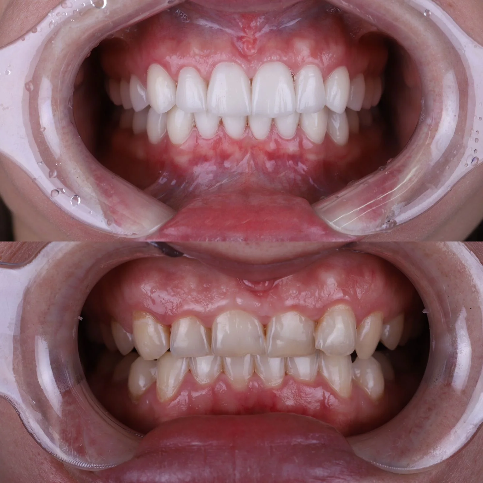 Dental before and after 4