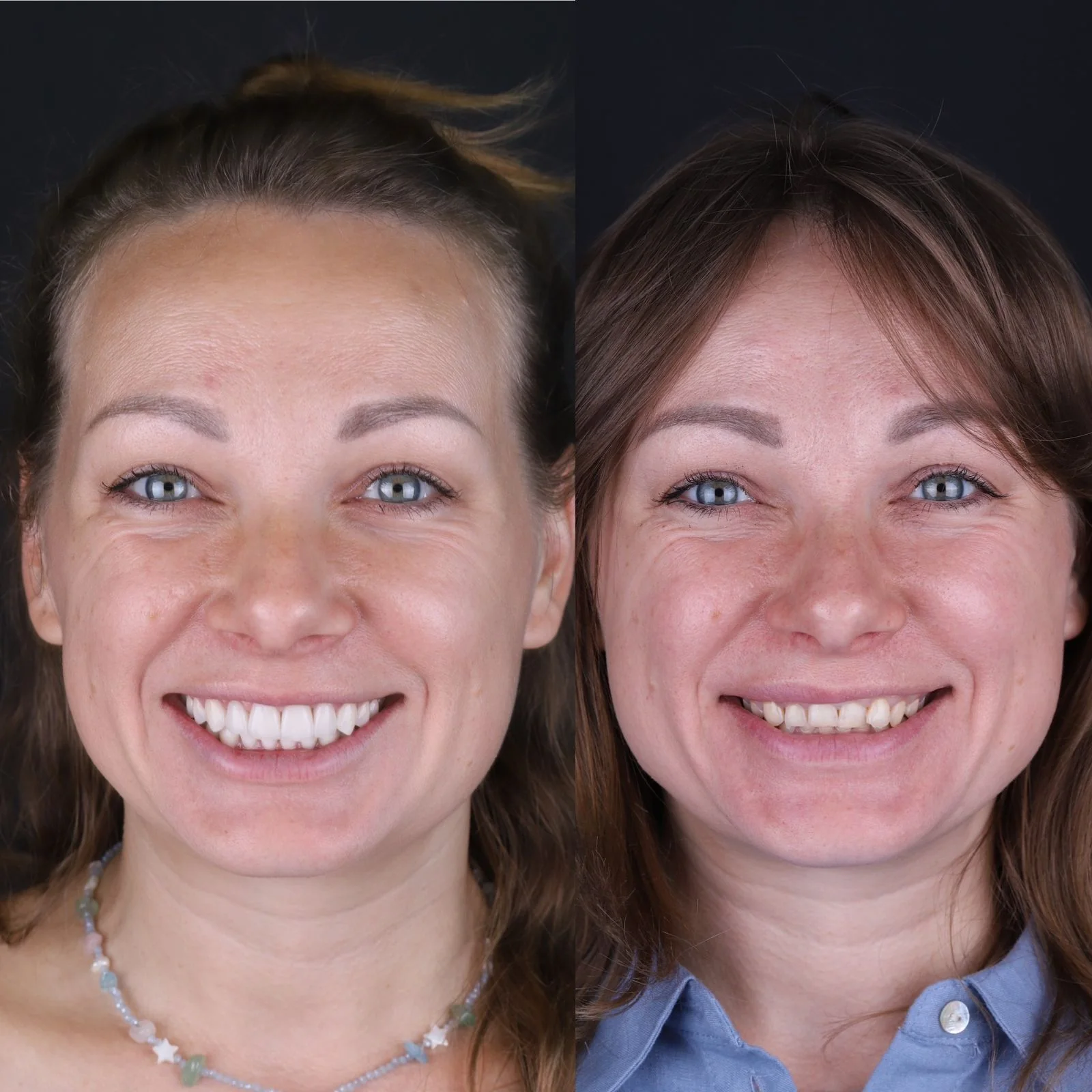 Dental before and after 14