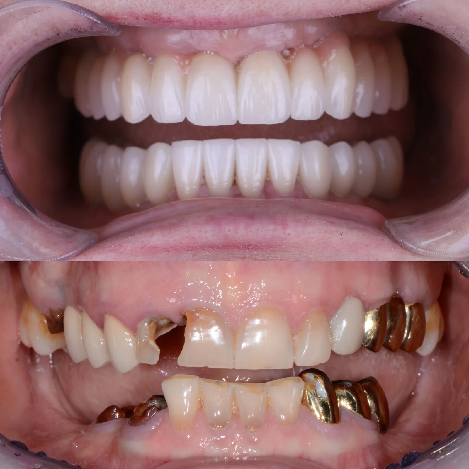 Dental before and after 30