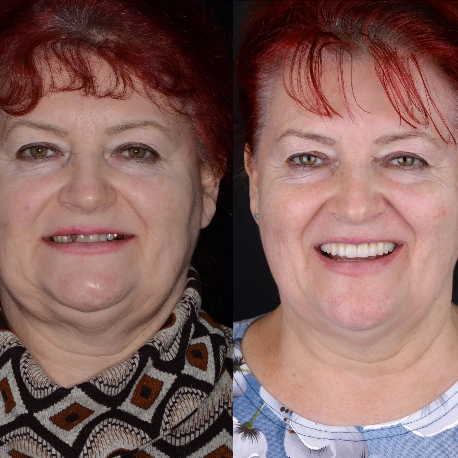 Dental before and after 31